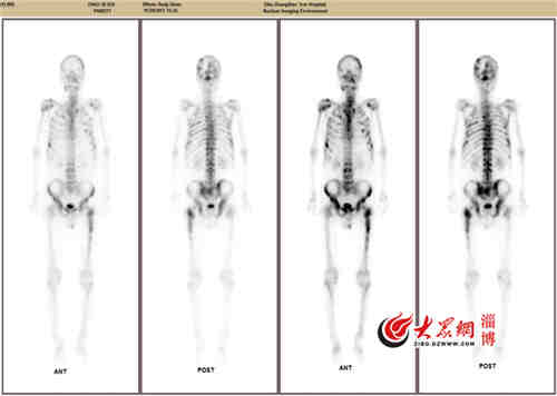 一次扫描全身成像 张店区中医院SPECT-CT提